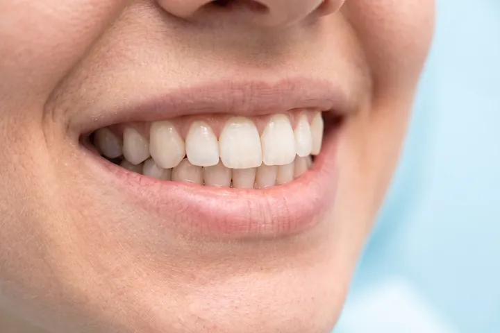 Sonrisa después del blanqueamiento, dientes más blancos